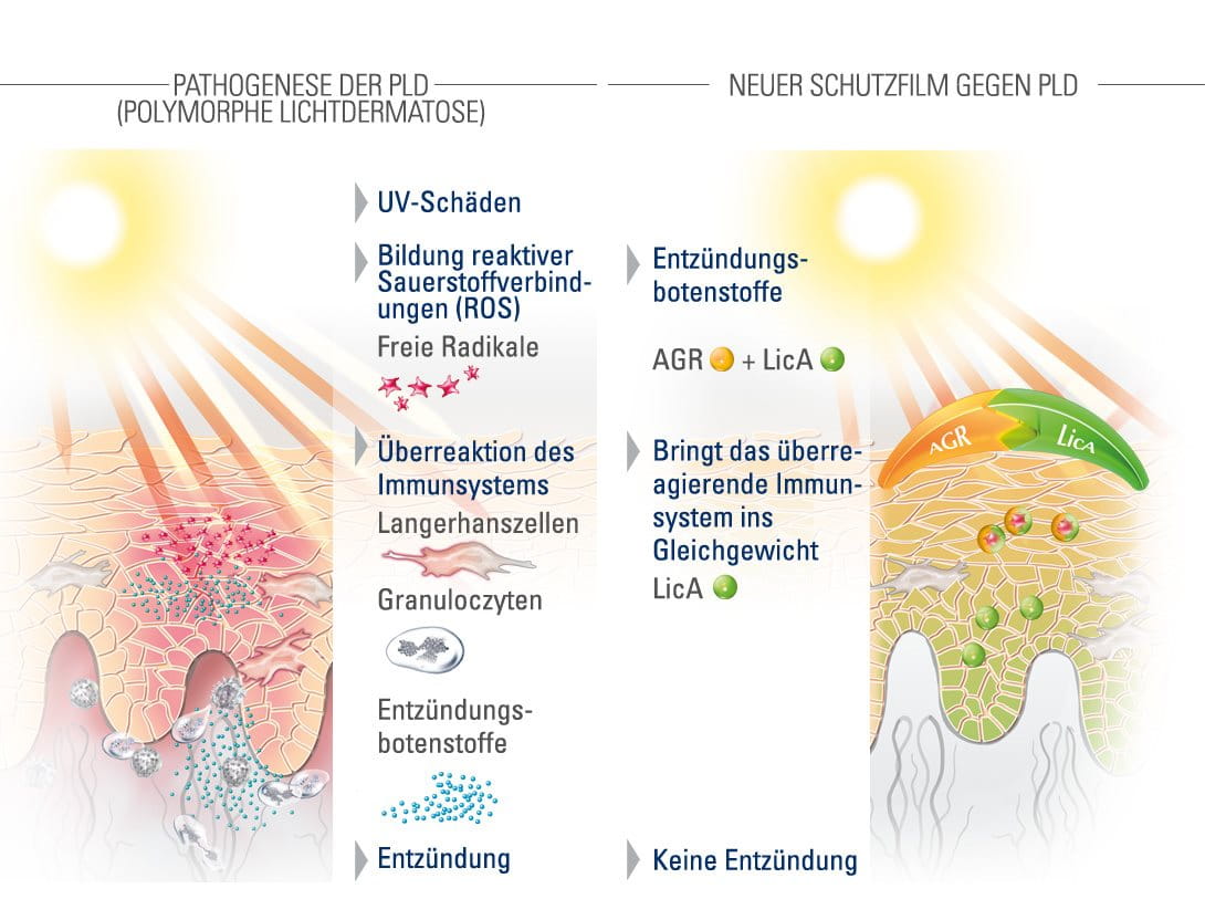 Sonnenallergie Antihistaminika